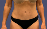 Abdominoplasty (Tummy Tuck) 7 After
